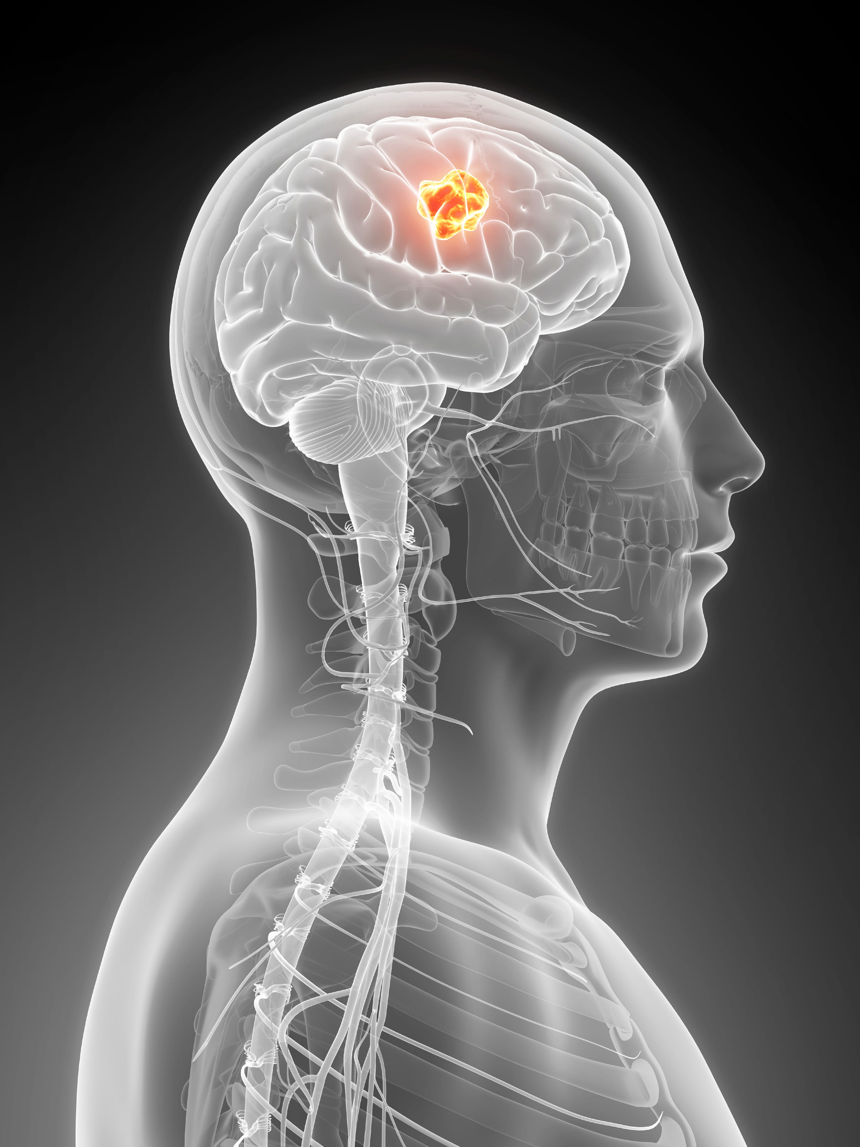 New Hope for Glioblastoma Treatment