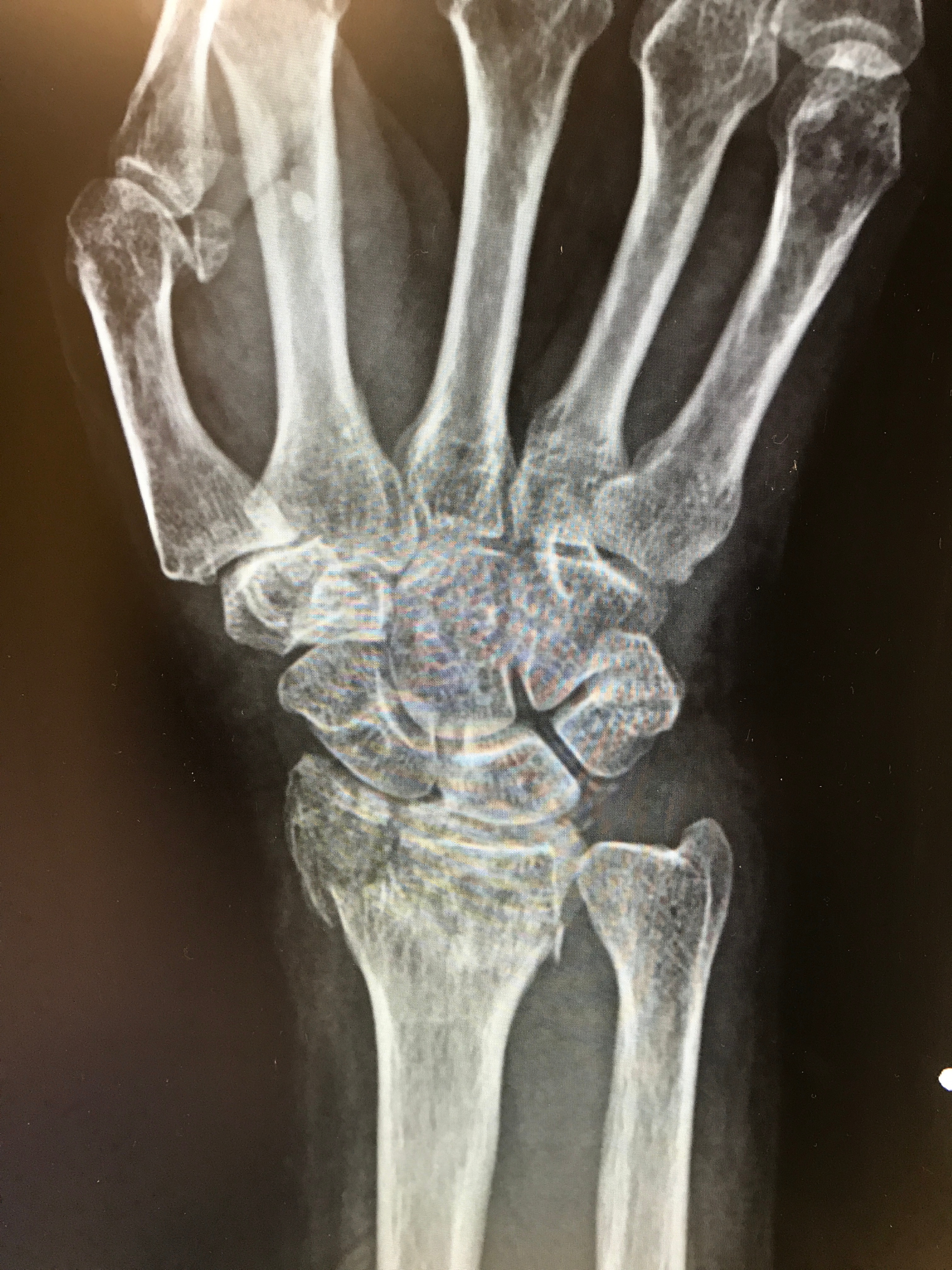 Diagnosing Pediatric Forearm Fractures: Radiograph or Ultrasound?
