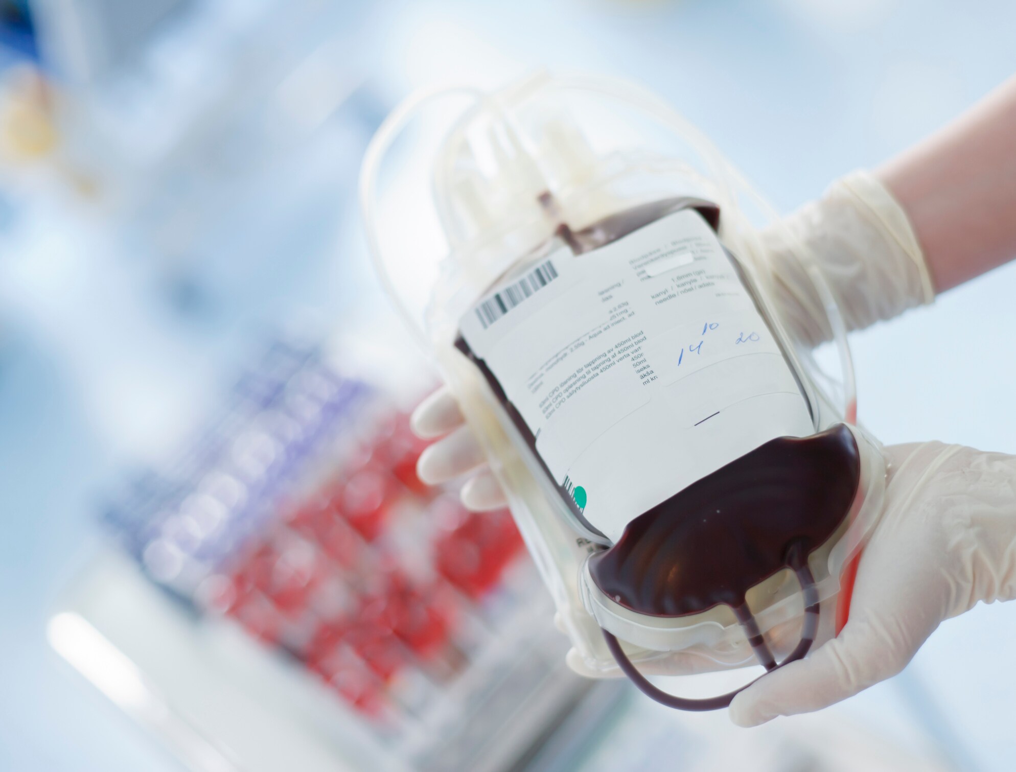 Greater Care Needed Over Transfusions in Sickle Cell Disease