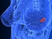 dt_150728_breast_cancer_tumor_800x600.jpg