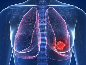 dt_160413_lung_cancer_tumor_800x600.jpg