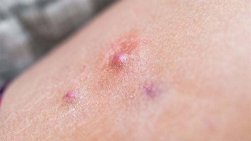 Hidradenitis Suppurativa Linked to Increased Mental Health Risks ...