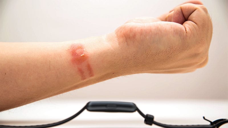 Allergic to Your Smartwatch? You’re Not Alone