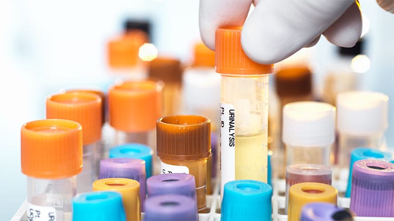 Urinary Sodium-Potassium Ratio May Signal Heart Health in RA