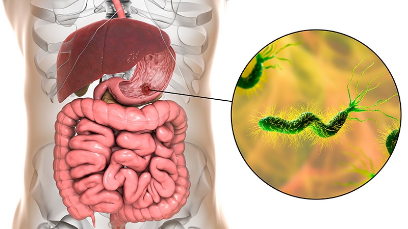 Second- and Third-Line Therapies Effective Against H pylori