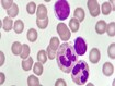 Blood smear of chronic lymphocytic leukemia (CLL), analyze by microscope