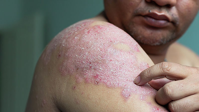 Psoriasis Affects an Estimated 3% of US Adults