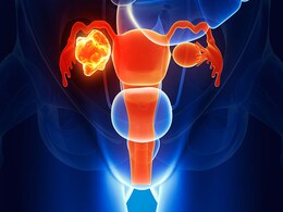 Female uterus with tumor, computer artwork.