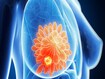 Human breast cancer, computer illustration.