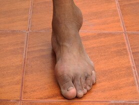 photo of Close-up gout on a human foot