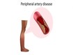 photo of  Peripheral artery disease