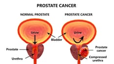MRI-Invisible Prostate Lesions: Are They Dangerous?