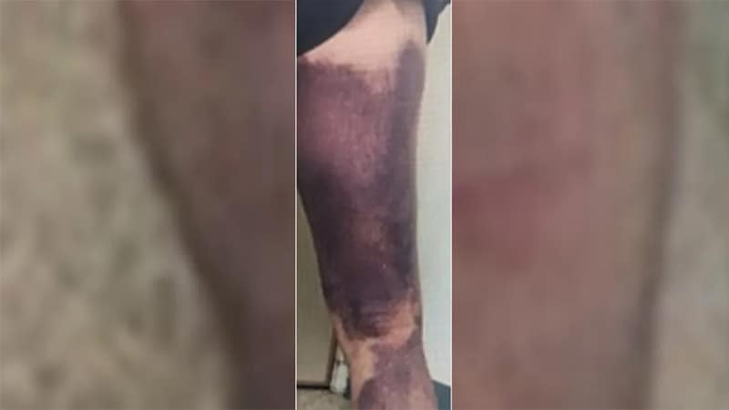 Fall: Ein Hämatom ohne Trauma – und die erstaunliche Diagnose dahinter