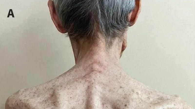 Fall: Ein 81-Jähriger mit verschwindender Rückenmuskulatur