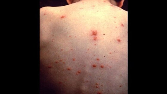 Vésicules sur le dos d’un enfant. Crédit&nbsp;: Centres de contrôle et de prévention des maladies des États-Unis (Centers for Disease Control and Prevention, CDC)