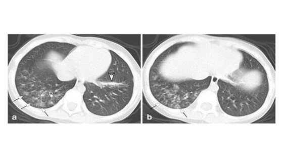 Image de Zhang Y, Xie RM, He YL, et al. Ital J Pediatr. 2020; 46: 153 (Creative Commons BY 4.0)