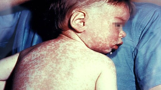 Enfant atteint de rougeole. Crédit&nbsp;: Russell W. Steele, MD