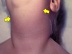 photo of Mumps
