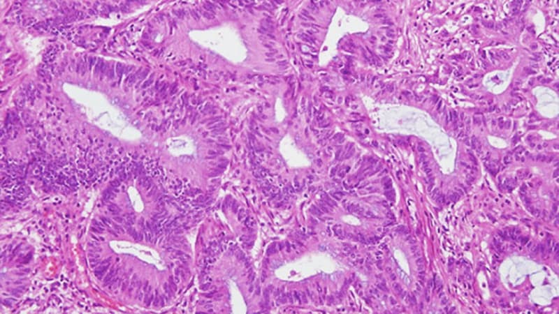 NICE Guidance on Testing for Lynch Syndrome in People with Endometrial NICE Guidance on Testing for Lynch Syndrome in People with Endometrial