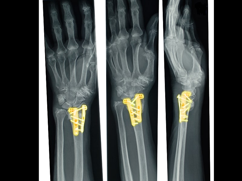 Safety Alert Over Wrong Fracture Fixation Plates